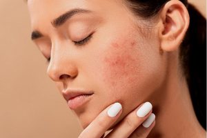 Comment se débarrasser de l’acné sur les joues?