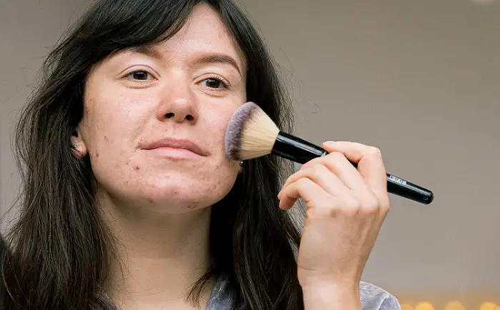 les solutions pour éliminer l'acné bas du visage 