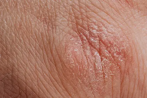 peau sèche ménopause les causes
